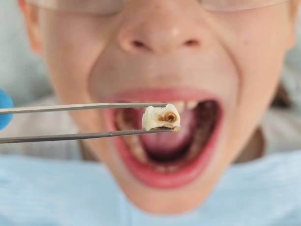 Best Knocked-Out Tooth (Avulsed Tooth) Treatment in China Grove, NC